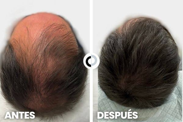Comparativa capilar antes y después, imagen 1