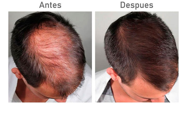 Comparativa capilar antes y después, imagen 2